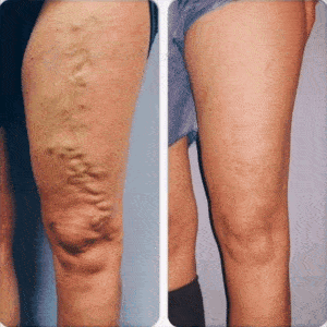 Crema pentru Varice VenoStop
